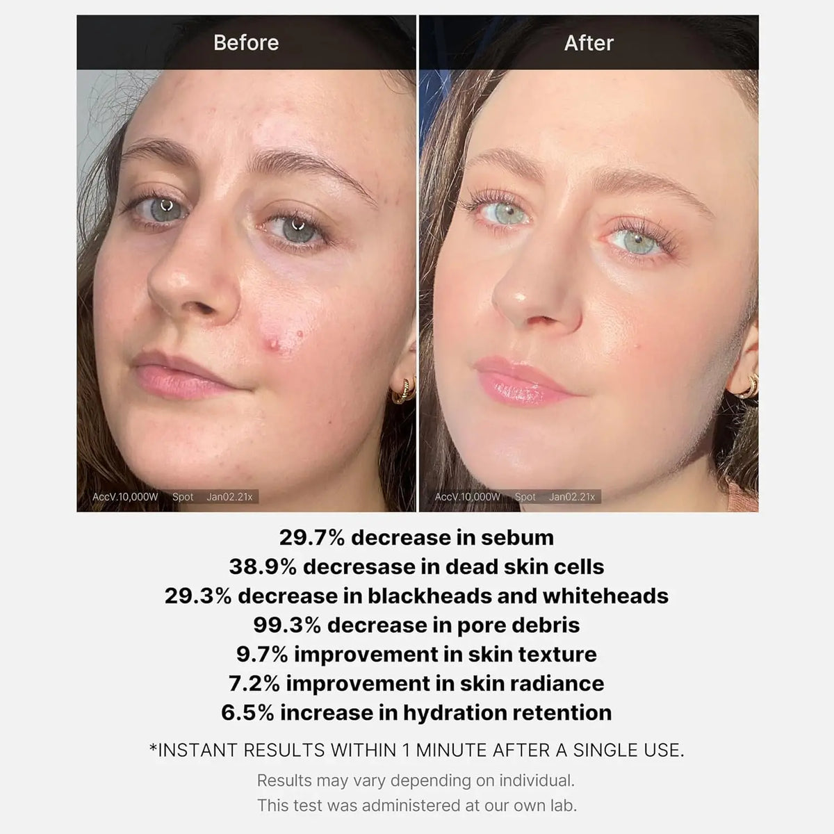 Before and after skin texture on breakout-prone skin